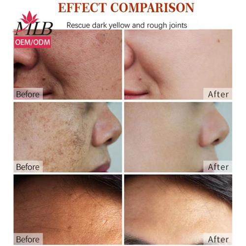 Crema per la rimozione delle macchie scure
